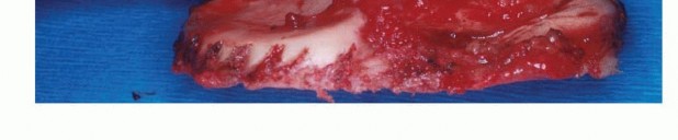 Illustration 15 for Precision Biopsy of Musculoskeletal Tumors for Accurate Diagnosis