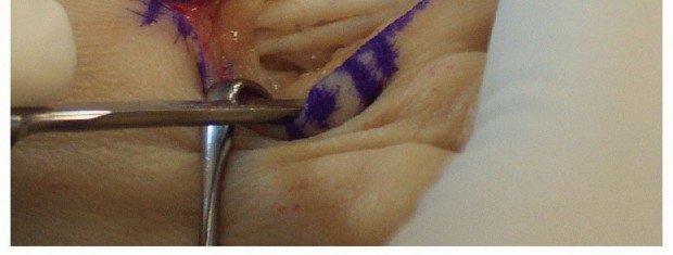 Illustration 21 for Hammer Toe Correction: Understanding the Extensor Digitorum Longus