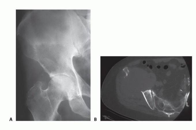 Illustration of plain radiograph showing - Dr. Mohammed Hutaif
