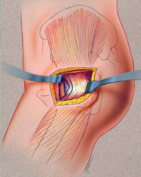 Illustration 6 for Unlock better THA: The technique of short stem for less invasiveness