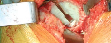 Illustration 25 for Optimizing Acetabular Component Cementation for Superior Outcomes