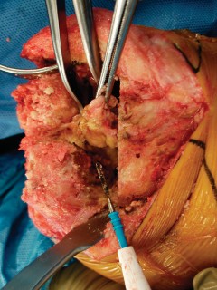Illustration 30 for Precision Soft Tissue Balancing in Revision: Avoid TKA Pitfalls