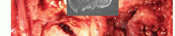 Illustration 20 for Distal Humeral Fractures: When Is Elbow Replacement the Best Option?