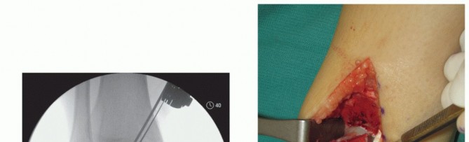 Illustration 5 for Unlock Healing: Medial Malleolar Osteotomy for Talus OLT Allografts