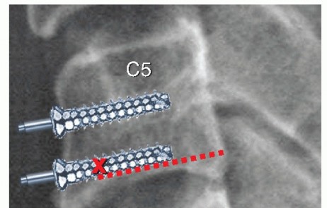Illustration 12 for How ACDF Clears Your Posterior Disc Space for Lasting Relief