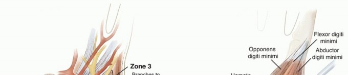 Decompression of the Ulnar Nerve at Guyon Canal