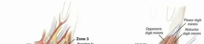 متلازمة النفق الرسغي الزندي (نفق غويون): دليل المريض الشامل مع الأستاذ الدكتور محمد هطيف