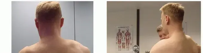 صورة توضيحية لـ تثبيت لوح الكتف الصدري: الحل النهائي لآلام الكتف المعقدة وانحراف لوح الكتف – دليلك الشامل مع الأستاذ الدكتور محمد هطيف