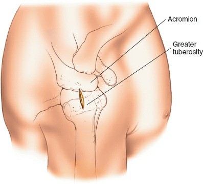 Illustration 120 for Essential Guide: Mastering Every Approach to the Shoulder