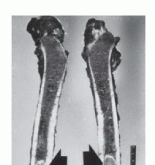Illustration 6 for Precision Biopsy of Musculoskeletal Tumors for Accurate Diagnosis