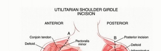 Illustration 20 for Limb-Sparing Resections Around the Shoulder: Optimizing Outcomes
