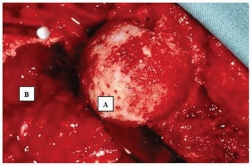 Illustration 18 for Hip Arthrodesis: The Definitive Hip Solution for Active Young Adults
