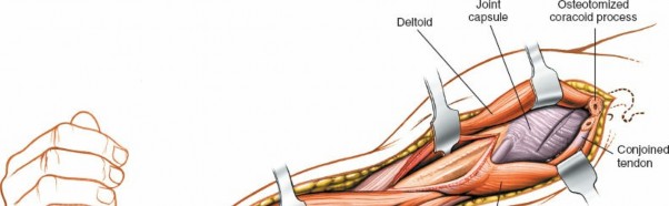 Illustration 19 for Mastering the Approach to the Distal Humerus: Safety & Skills