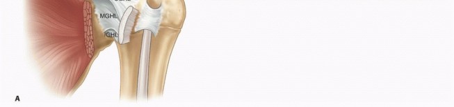 Illustration 2 for Stiff Shoulder? Discover Arthroscopic Capsular Release Solutions