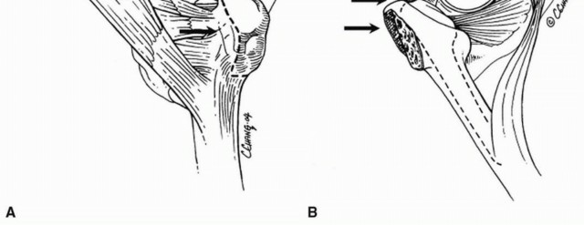 Illustration 37 for Sliding Trochanteric Osteotomy: Modern Role & Refined Techniques