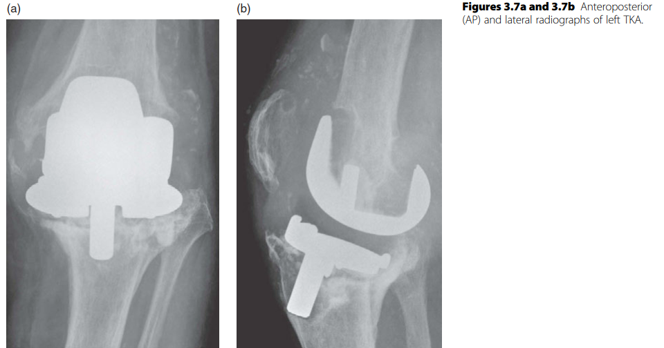 Revision Knee Replacement: Master Challenges with Expert Q&A