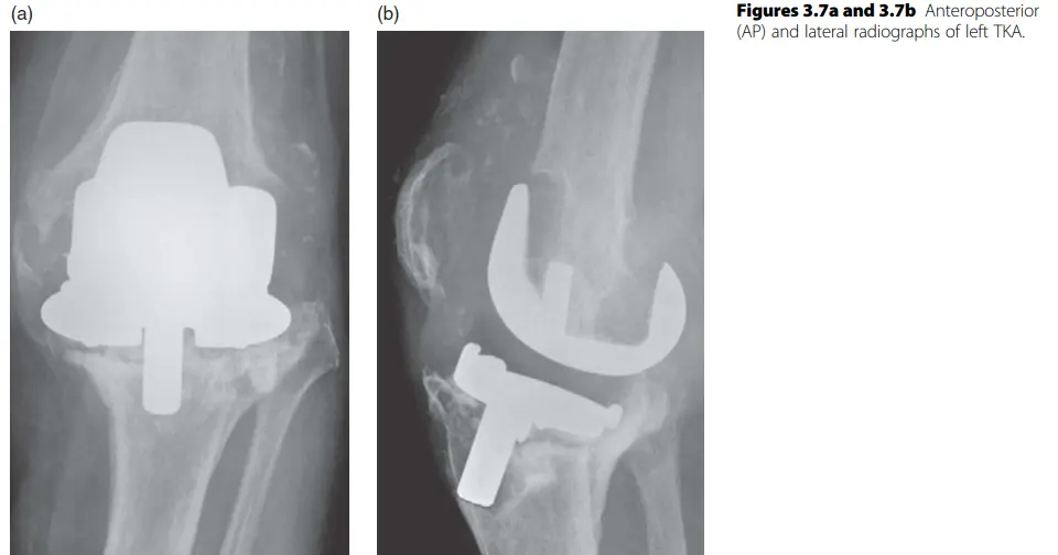صورة توضيحية لـ تبديل الركبة المراجع: دليل شامل للمرضى لاستعادة الحركة مع الأستاذ الدكتور محمد هطيف