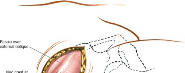 Illustration 6 for Pelvis & Acetabulum Approaches: Unlocking the Posterior Superior Iliac