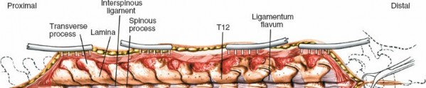 Illustration 363 for Approach to the Lumbar Spine: Mastering Techniques & Anatomy