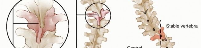 Illustration 11 for Adult Scoliosis: Uncover Causes & Find Lasting Back Pain Relief