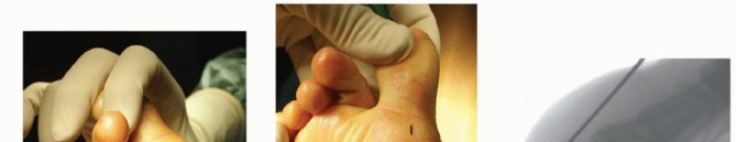 Illustration 11 for Optimizing Internal Fixation of Sesamoid Fractures