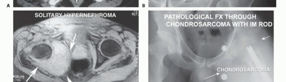 Illustration 5 for Posterior Flap Hemipelvectomy: Mastering Techniques for Optimal Outcomes