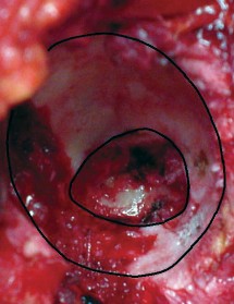 Illustration 25 for Mastering the Cementless Acetabular Cup: Techniques for Optimal Fixation