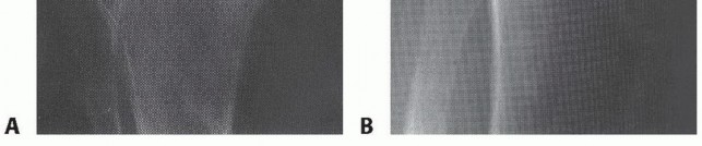 Illustration 25 for Dissecans of the Knee: What's the Difference – OCD vs. AVN?