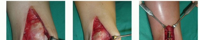 Illustration 30 for Painful Talus Lesions? The tech fig c Osteochondral Transfer Solution