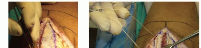 Illustration 33 for Radial Head & Neck Fractures: Mastering ORIF for Best Results