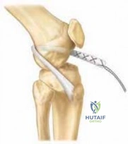 الدليل الشامل لعلاج تمزق الرباط الزورقي الهلالي وعدم استقرار الرسغ