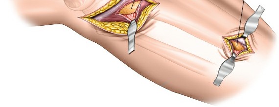 Illustration 54 for Surgical Access: Mastering the Tibia's Surface & Fibula Approaches