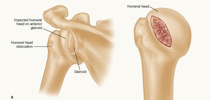 Mastering the management of glenohumeral instability with humeral bone loss