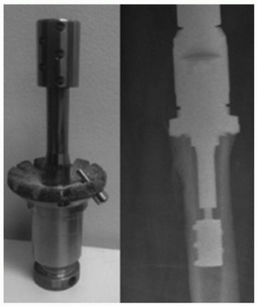 Illustration 40 for Allograft Prosthetic Composite: Mastering Proximal Femur Reconstruction