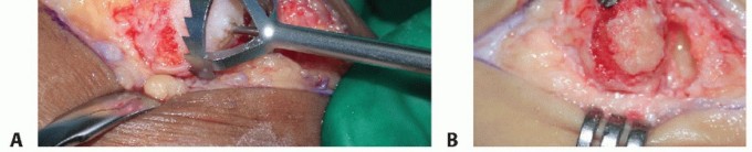 Illustration 8 for MTP Joint Arthrodesis: The Key to Optimal Toe Positioning