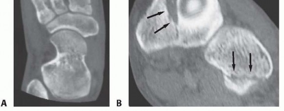 Illustration 9 for Fixation of Lisfranc Injuries: Essential Open Reduction Guide
