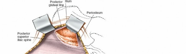 Illustration 13 for Pelvis & Acetabulum Approaches: Unlocking the Posterior Superior Iliac