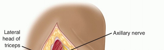 Illustration 23 for Surgical Approaches to Shoulder & Elbow: Pearls and Pitfalls