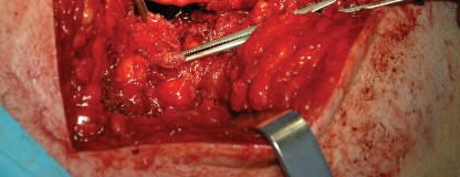 Illustration 103 for Femoral Stem Revision: Posterior Approach for Better Outcomes