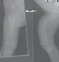 صورة توضيحية لـ التقويم الجراحي المتطور لتشوهات العظام لدى الأطفال: حل دائم لمرض العظام الزجاجية (التعظم الناقص)