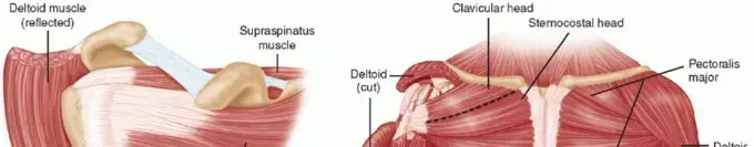 وداعاً لألم الكتف المزمن: دليل شامل لعلاج تمزق الوتر تحت الكتفي غير القابل للإصلاح بتقنية نقل العضلة الصدرية الكبرى