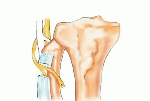صورة توضيحية لـ استئصال أورام الشظية: دليل شامل للعلاج الحديث والحفاظ على الأطراف مع الأستاذ الدكتور محمد هطيف