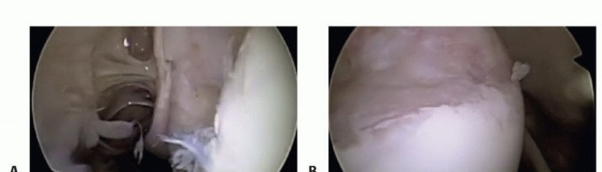 Illustration 31 for Regain Stability: Arthroscopy for Anterior Instability & the Inferior Glenohumeral Ligament