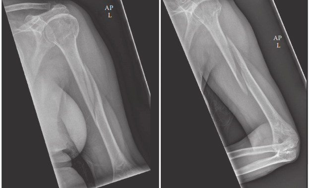 Midshaft Humerus Fractures: Epidemiology, Surgical Anatomy, Biomechanics & Management