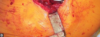 Illustration 57 for Exploring the Ambulatory Surgical Setting for Total Hip Replacement