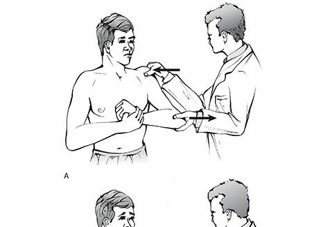 Illustration of anterior glenohumeral dislocation - Dr. Mohammed Hutaif