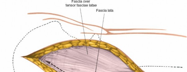 Illustration 103 for Unlocking Every Aspect of the Hip's Surgical Approaches