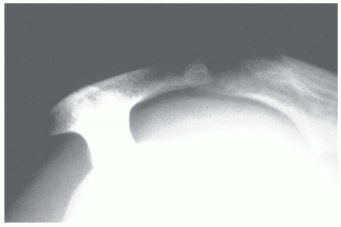 Illustration 13 for Subscapularis & Teres Rotator Cuff Repair: Advanced Techniques