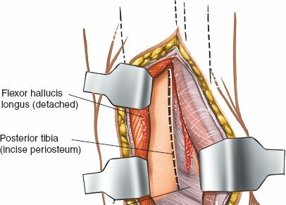 Illustration 76 for Optimized Approaches to the Dorsum of the Foot & Ankle