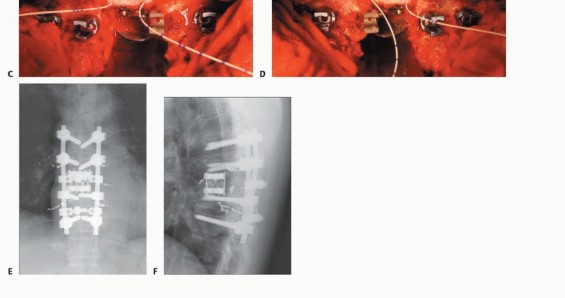 Illustration 32 for Total En Bloc Spondylectomy: Complete Resection for Spinal Tumors